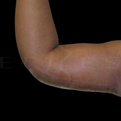 Arm Lift Before & After Patient #5180
