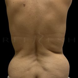 Bra Roll Before & After Patient #5444