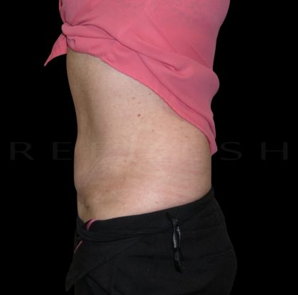 Mini Tummy Tuck Before & After Patient #5301