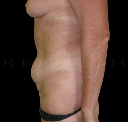 Mini Tummy Tuck Before & After Patient #5301