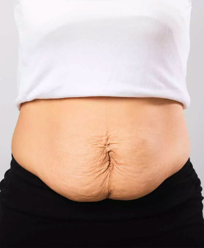 Post Pregnancy Tummy