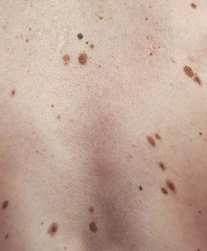 Skin Lesions