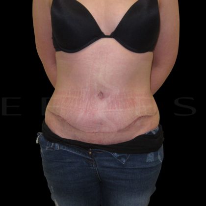 Tummy Tuck Before & After Patient #5372