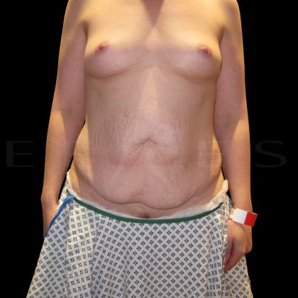 Tummy Tuck Before & After Patient #5372