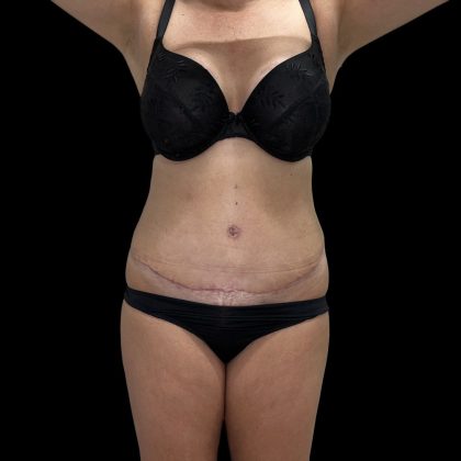 Tummy Tuck Before & After Patient #5406