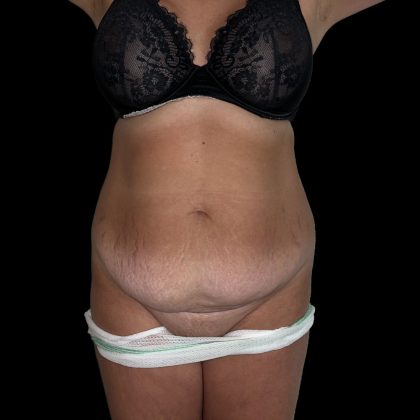 Tummy Tuck Before & After Patient #5406