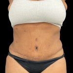 Tummy Tuck Before & After Patient #5409