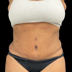Tummy Tuck Before & After Patient #5409