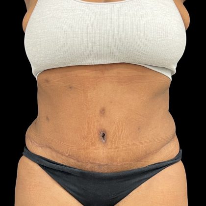 Tummy Tuck Before & After Patient #5409