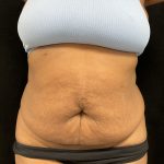 Tummy Tuck Before & After Patient #5409