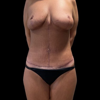 Tummy Tuck Before & After Patient #5412