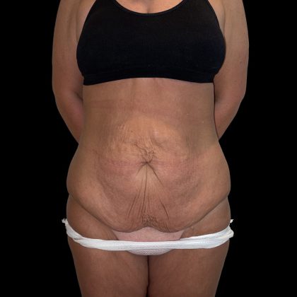 Tummy Tuck Before & After Patient #5412