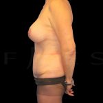 Tummy Tuck Before & After Patient #5376