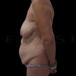 Tummy Tuck Before & After Patient #5376
