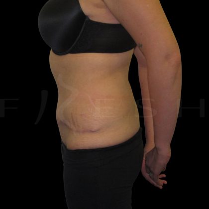 Tummy Tuck Before & After Patient #5386