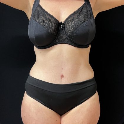 Tummy Tuck Before & After Patient #5395