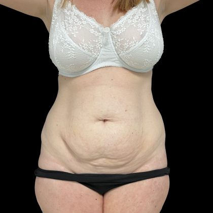 Tummy Tuck Before & After Patient #5395