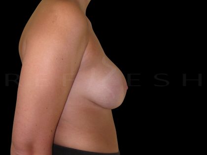 Breast Implant Removal Before & After Patient #6569