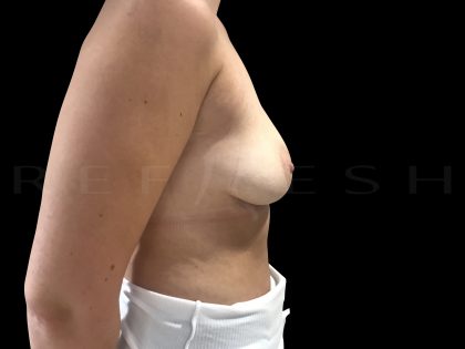 Breast Implant Removal Before & After Patient #6569