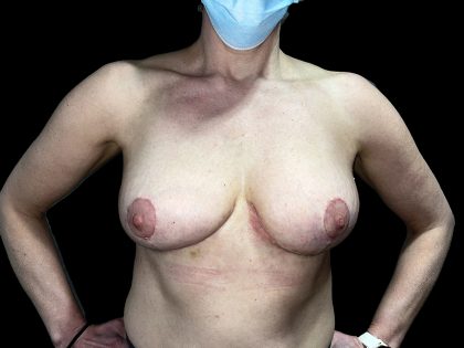 Accessory Breast Tissue Before & After Patient #6675