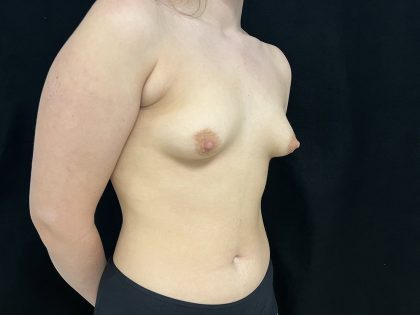 Accessory Breast Tissue Before & After Patient #6673