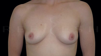 Areola Reduction Before & After Patient #6524