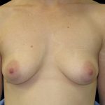 Areola Reduction Before & After Patient #6524