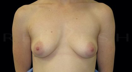 Areola Reduction Before & After Patient #6524