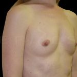 Breast Augmentation Before & After Patient #6546