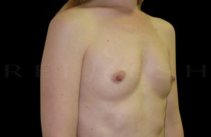 Breast Augmentation Before & After Patient #6546