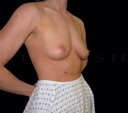 Breast Augmentation Before & After Patient #6547