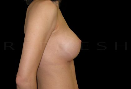 Breast Augmentation Before & After Patient #6532