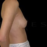 Breast Augmentation Before & After Patient #6532