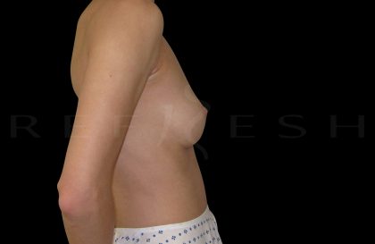 Breast Augmentation Before & After Patient #6532