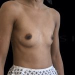 Breast Augmentation Before & After Patient #6531