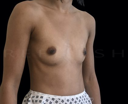 Breast Augmentation Before & After Patient #6531