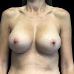 Breast Augmentation Before & After Patient #6530