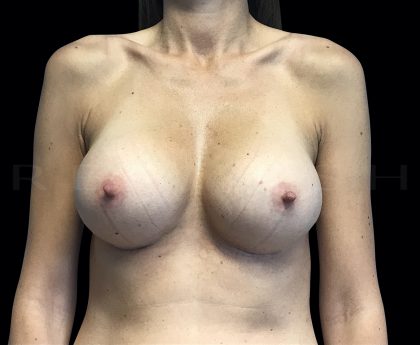 Breast Augmentation Before & After Patient #6530