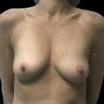 Breast Augmentation Before & After Patient #6530