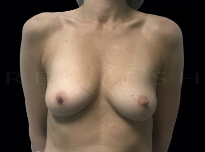 Breast Augmentation Before & After Patient #6530