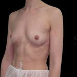 Breast Augmentation Before & After Patient #6528