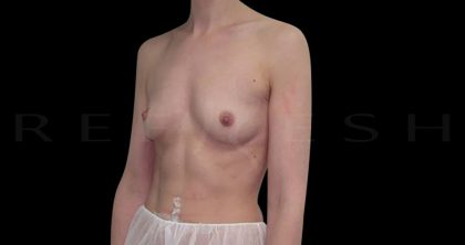 Breast Augmentation Before & After Patient #6528