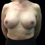 Breast Augmentation Before & After Patient #6526