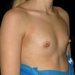 Breast Augmentation Before & After Patient #6544