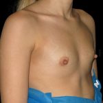 Breast Augmentation Before & After Patient #6544