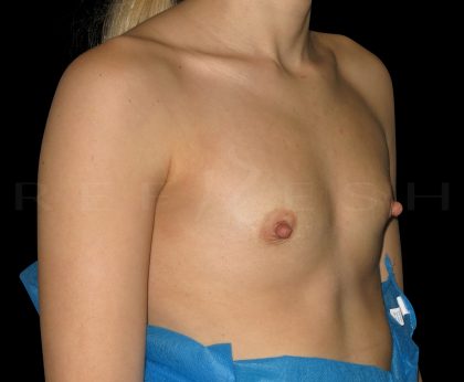 Breast Augmentation Before & After Patient #6544