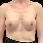 Breast Augmentation Before & After Patient #6541