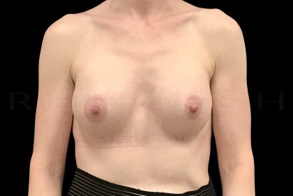 Breast Augmentation Before & After Patient #6541