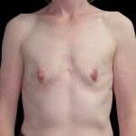 Breast Augmentation Before & After Patient #6541