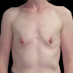 Breast Augmentation Before & After Patient #6541